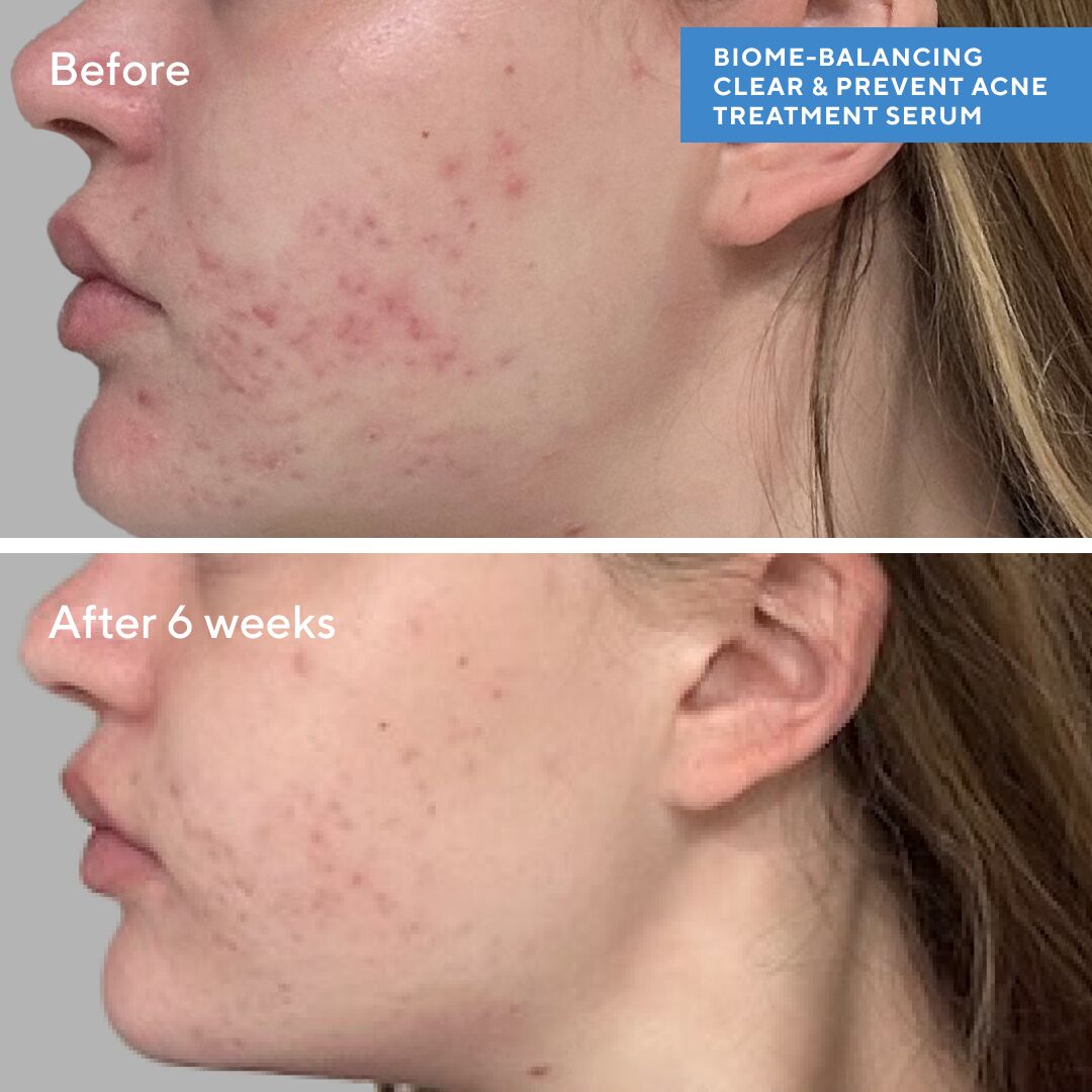 High_Res-696851_Biome-Balancing_Acne_Serum_BA_6wks_MR_Right_Social_WithProductName
