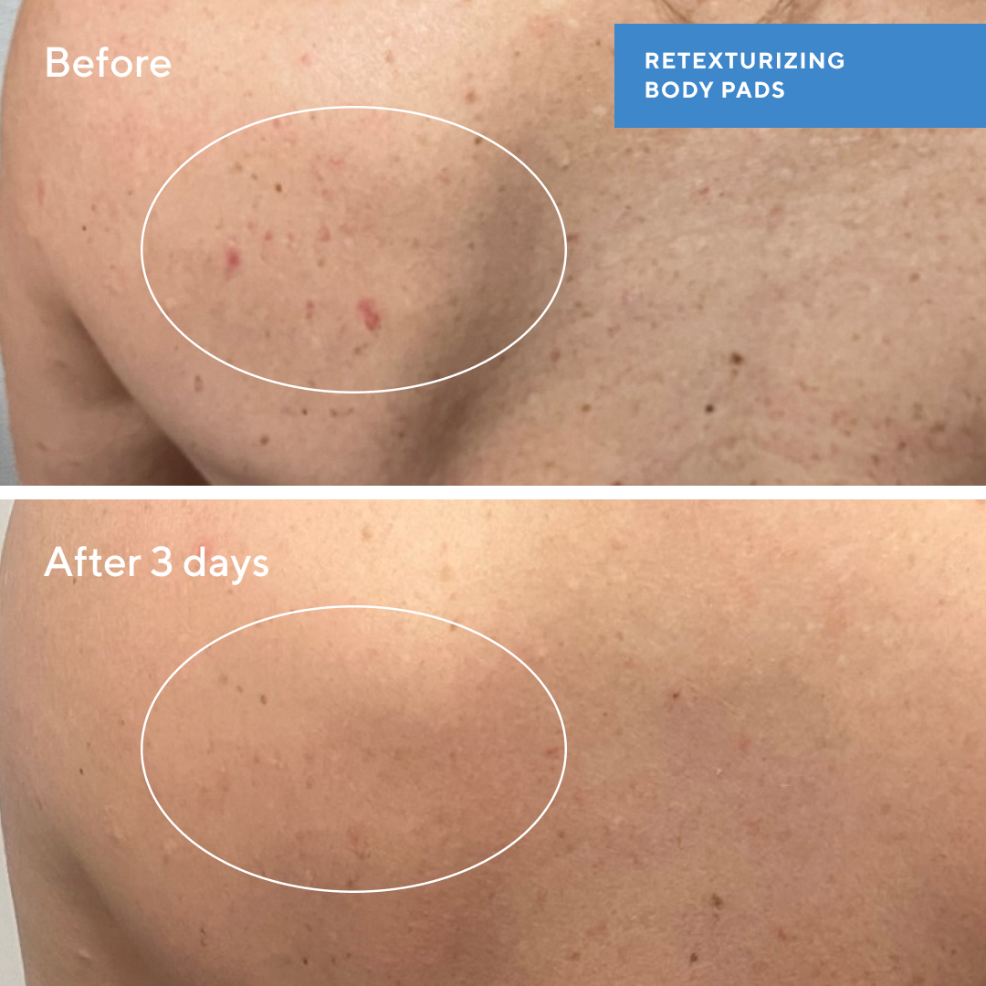 PNG-557297_July24_ClarifyingBodyPads_BA_AC-43-17 M.R_Social_WithProductName